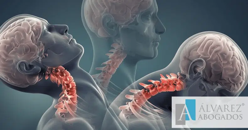 Indemnización Esguince Cervical Tenerife